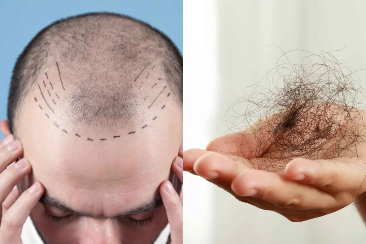Experts Explain Causes, Vitamins, and How to Stop Hair Fall in Young Adults