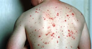 Wake County Measles Outbreak Alert 2026 Exposure at 5 Raleigh Locations Including Harris Teeter & O2 Fitness — What Residents Need to Know